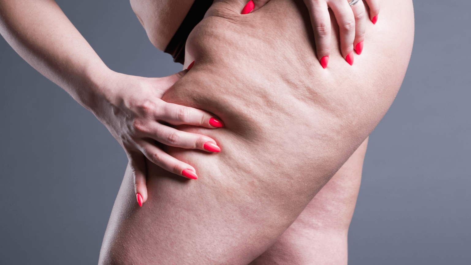 cellulite on woman's thigh